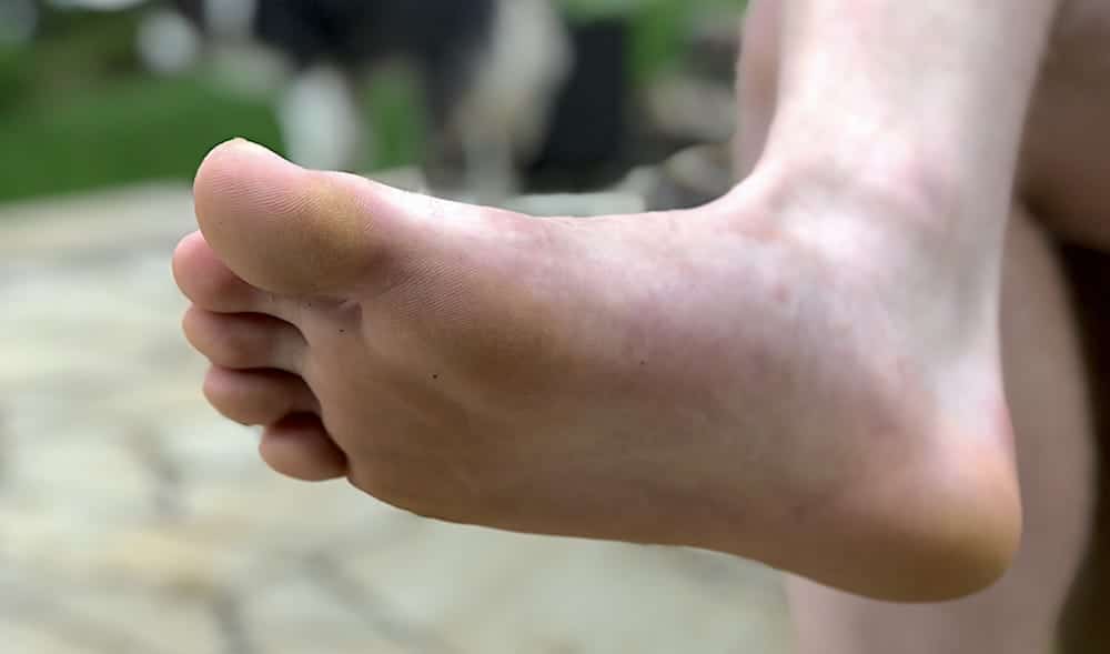 Foot Calluses Prevention and Treatment Tips Feet First Clinic