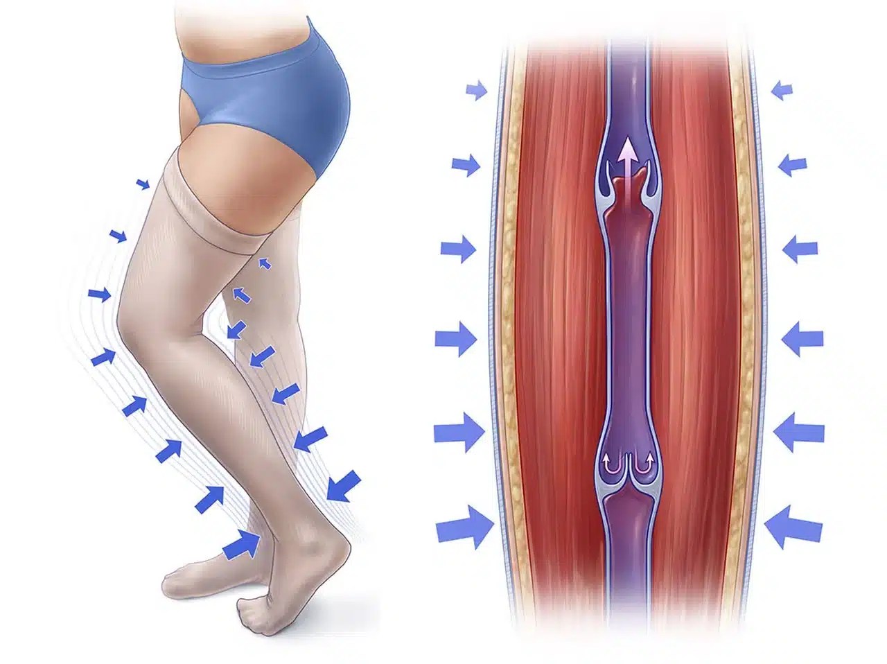 The Best Compression Stockings for Varicose Veins How to Choose the