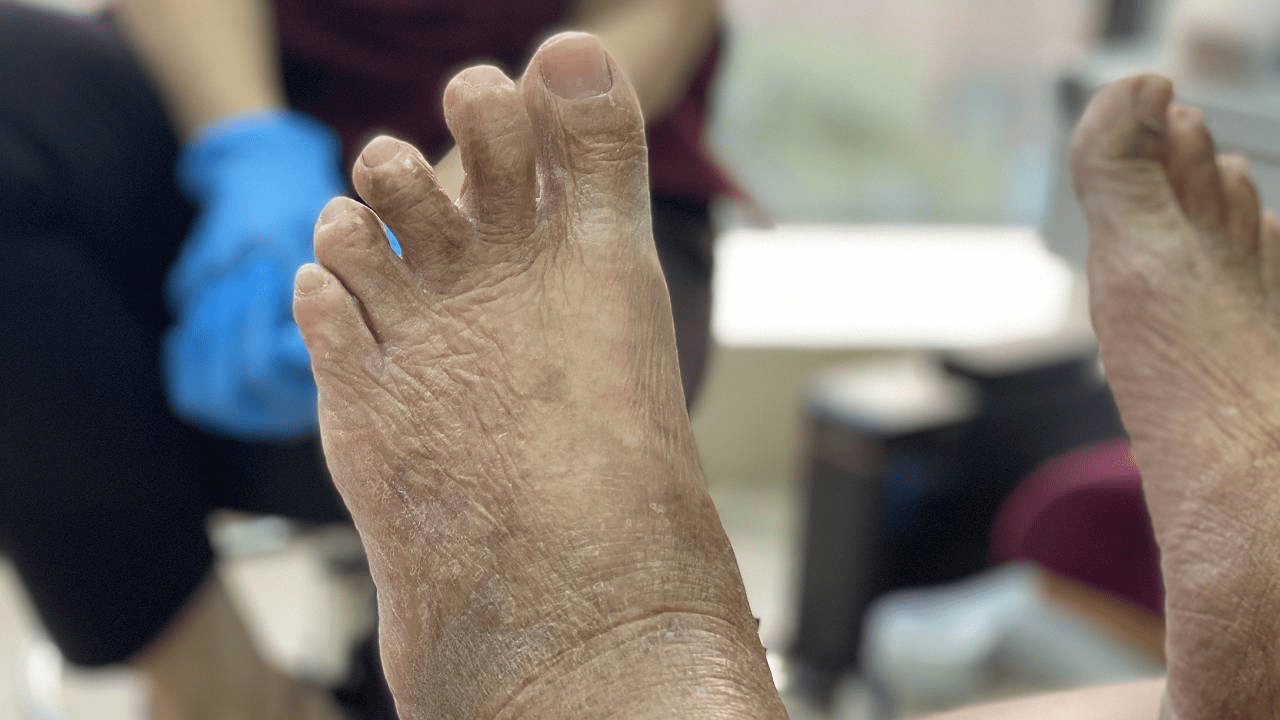 Plantar plate tears — Podiatry & Foot Care in Belfast Feet Street