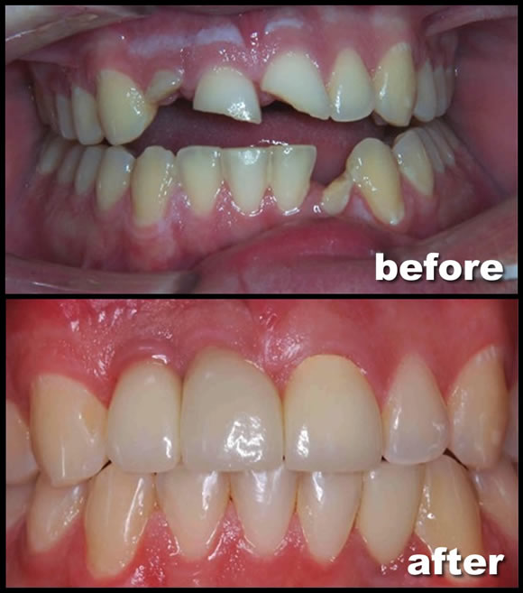 Dental Implant Restoration Feild Family Dentistry