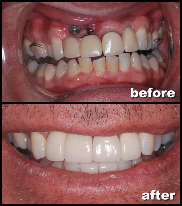 Cosmetic Dental Implants Feild Family Dentistry