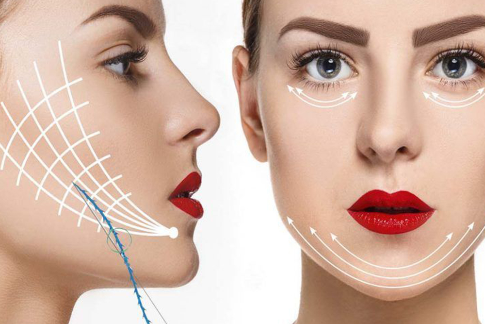 LIFTING CON HILOS TENSORES Centro de estética en Pinto