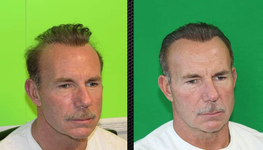 Dr. Bloxham Discusses a Repair Case of Old "Hair Plugs" Feller