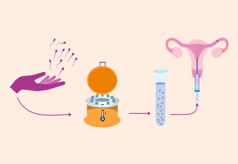 IUI Step by Step Everything You Need to Know