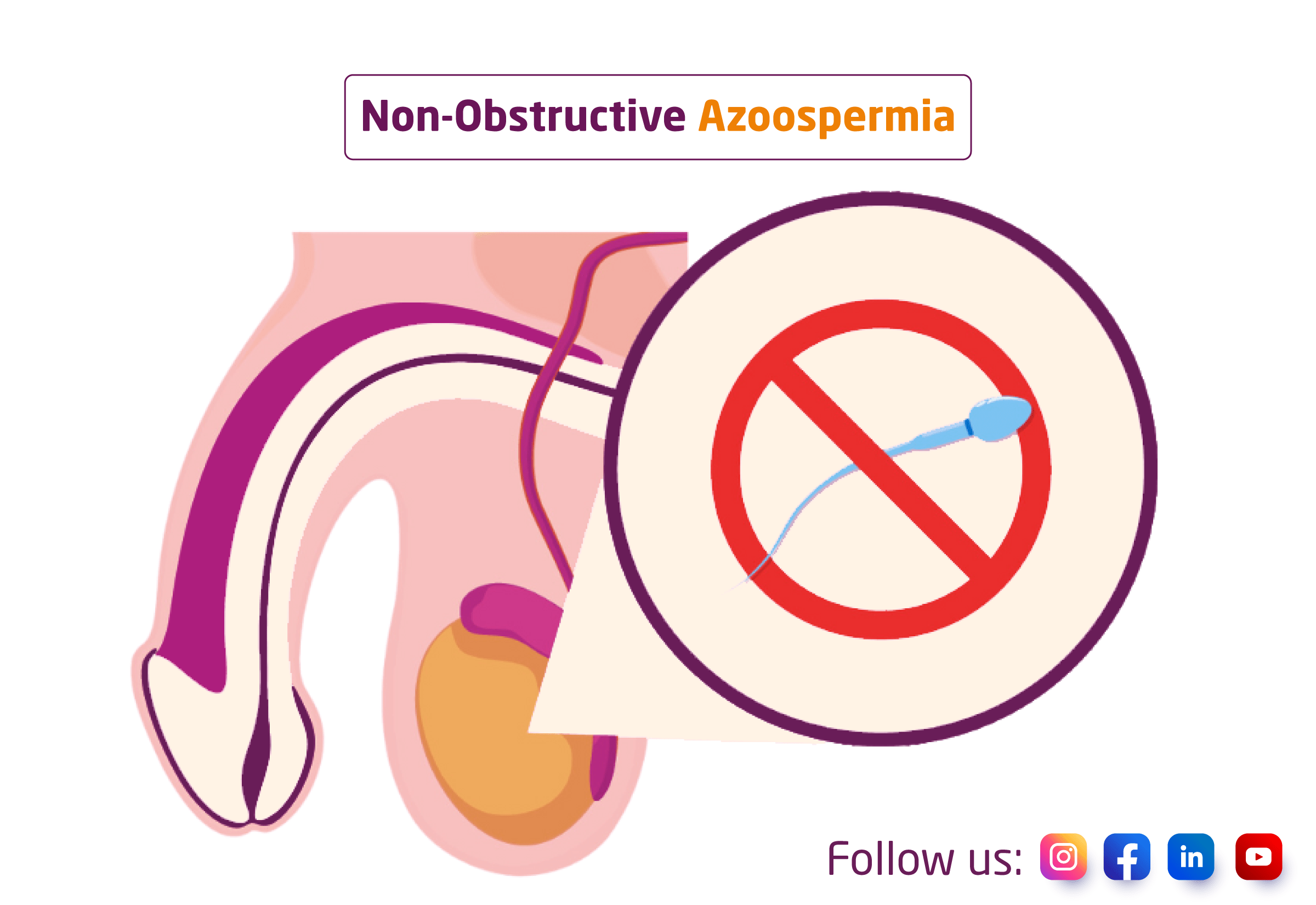 Nonobstructive Azoospermia Causes & Treatment