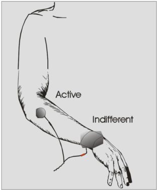 NMES Electrode Placement