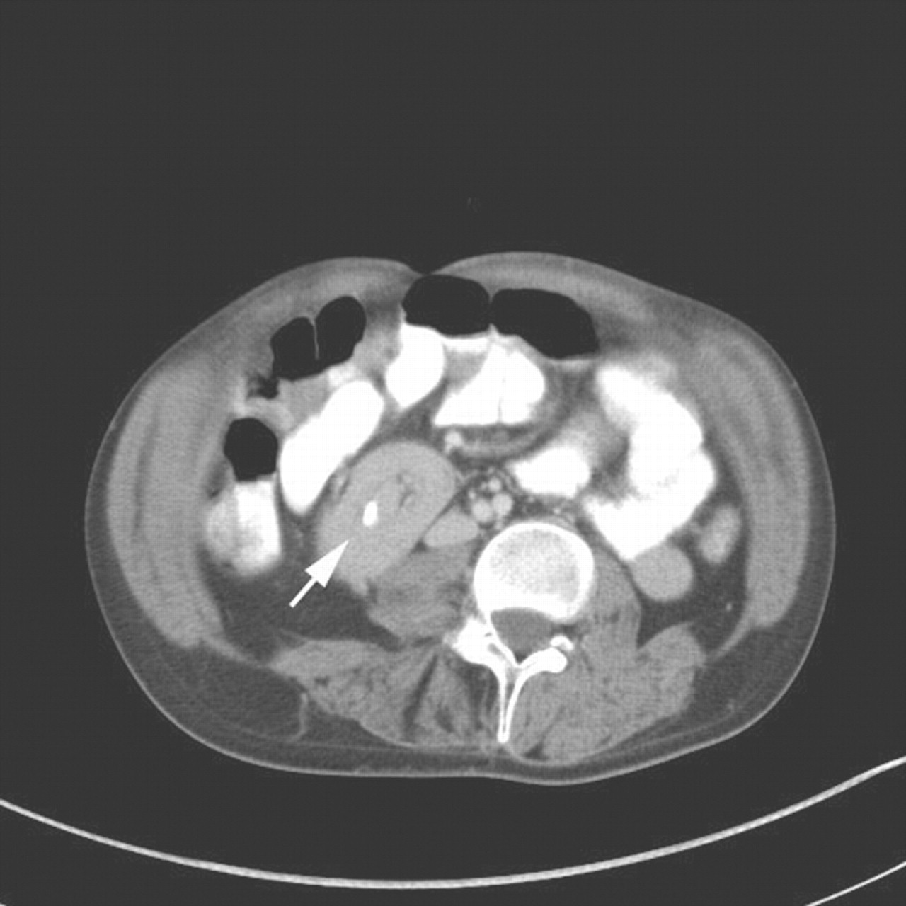 Identifying small bowel intussusception related to a gastroenteric