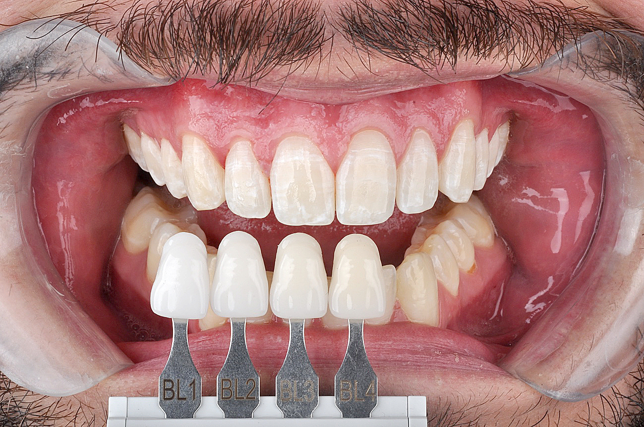 Blanqueamiento casero y microabrasión