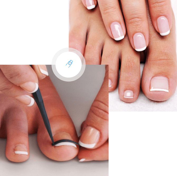 Ingrown Nail Foundation Health Johnson City, TN