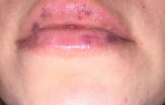 White Spots Lip Fillers