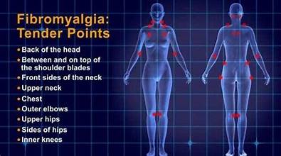 Fibromyalgia Tender Points: What and Where Are They? – fibromyalgia