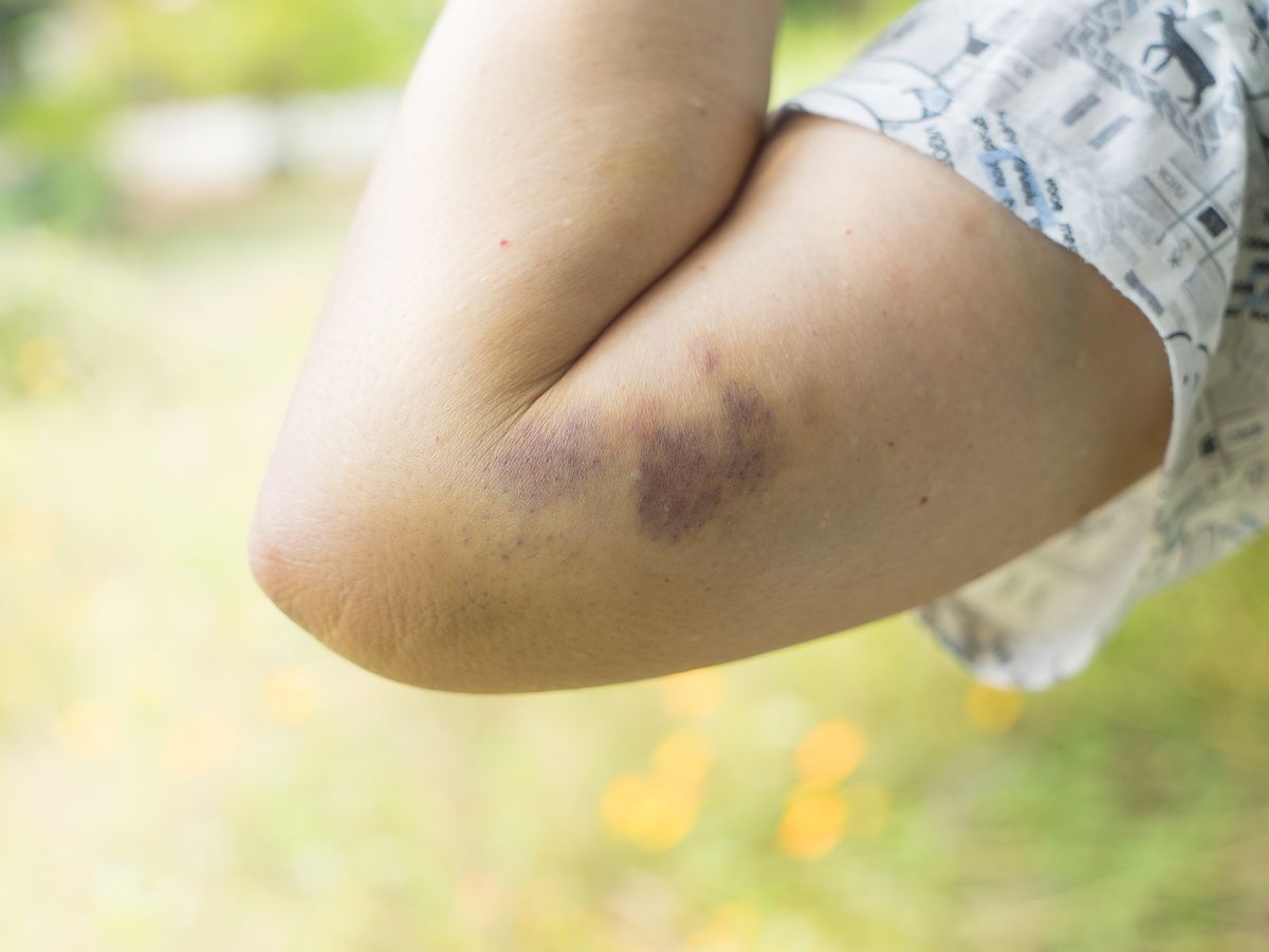 Fibromyalgia and increased bruising or unexplained bruising. Possible