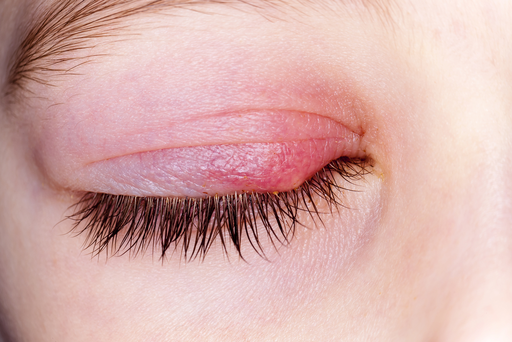 » Blepharitis and Fibromyalgia