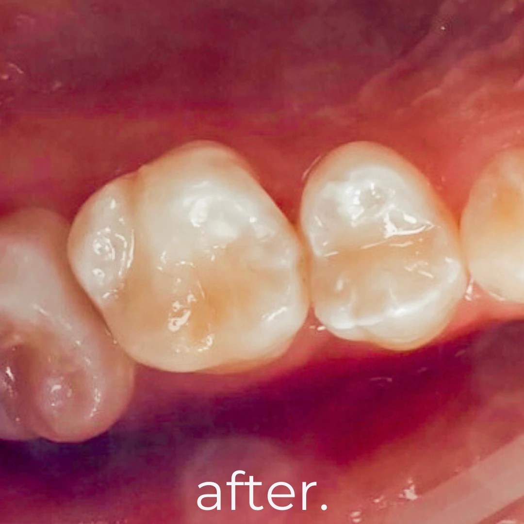 Treatments & Portfolio Fidelity Dental Bali