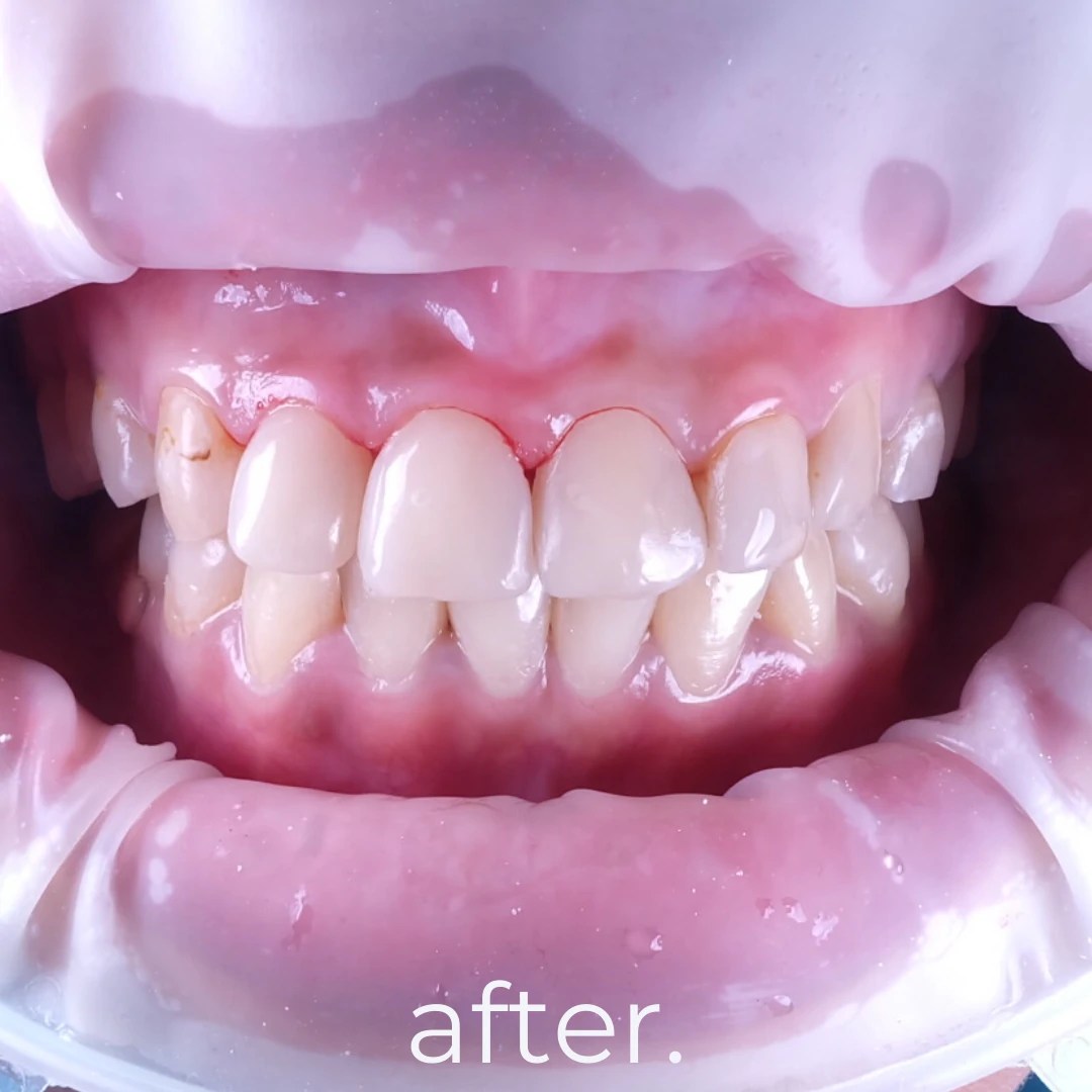 Aesthetic & Painless Dental / Tooth Composite Filling Fidelity Dental