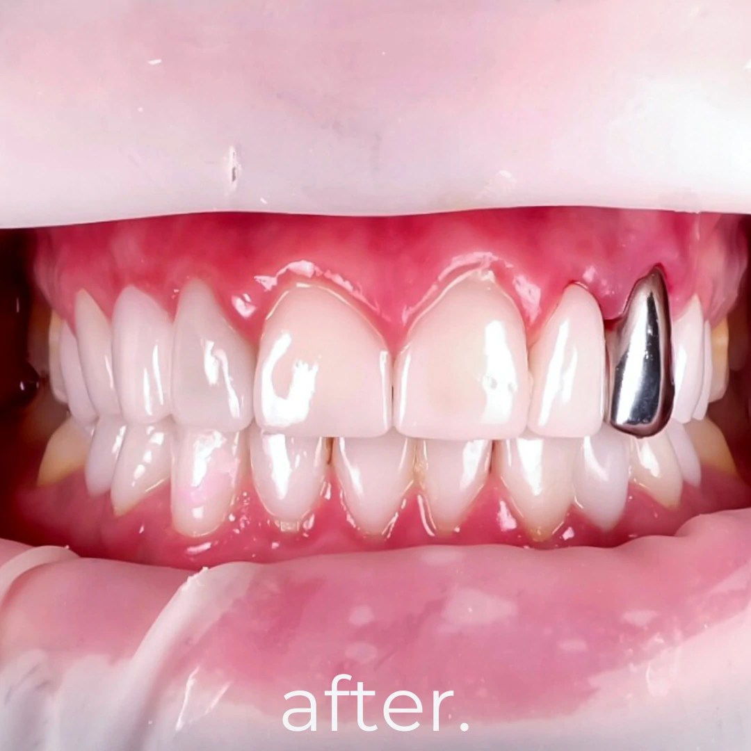 Dental Crowns Fidelity Dental Bali