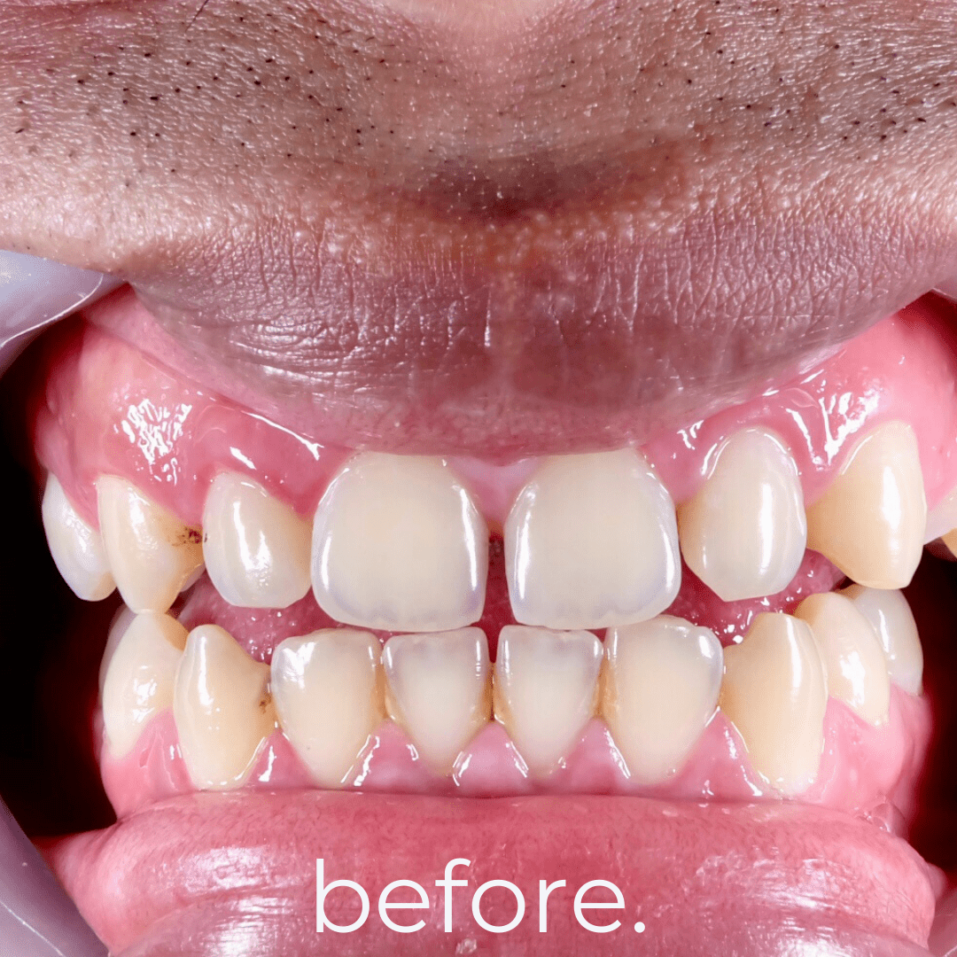 Direct Veneers / Composite Bonding Fidelity Dental Bali