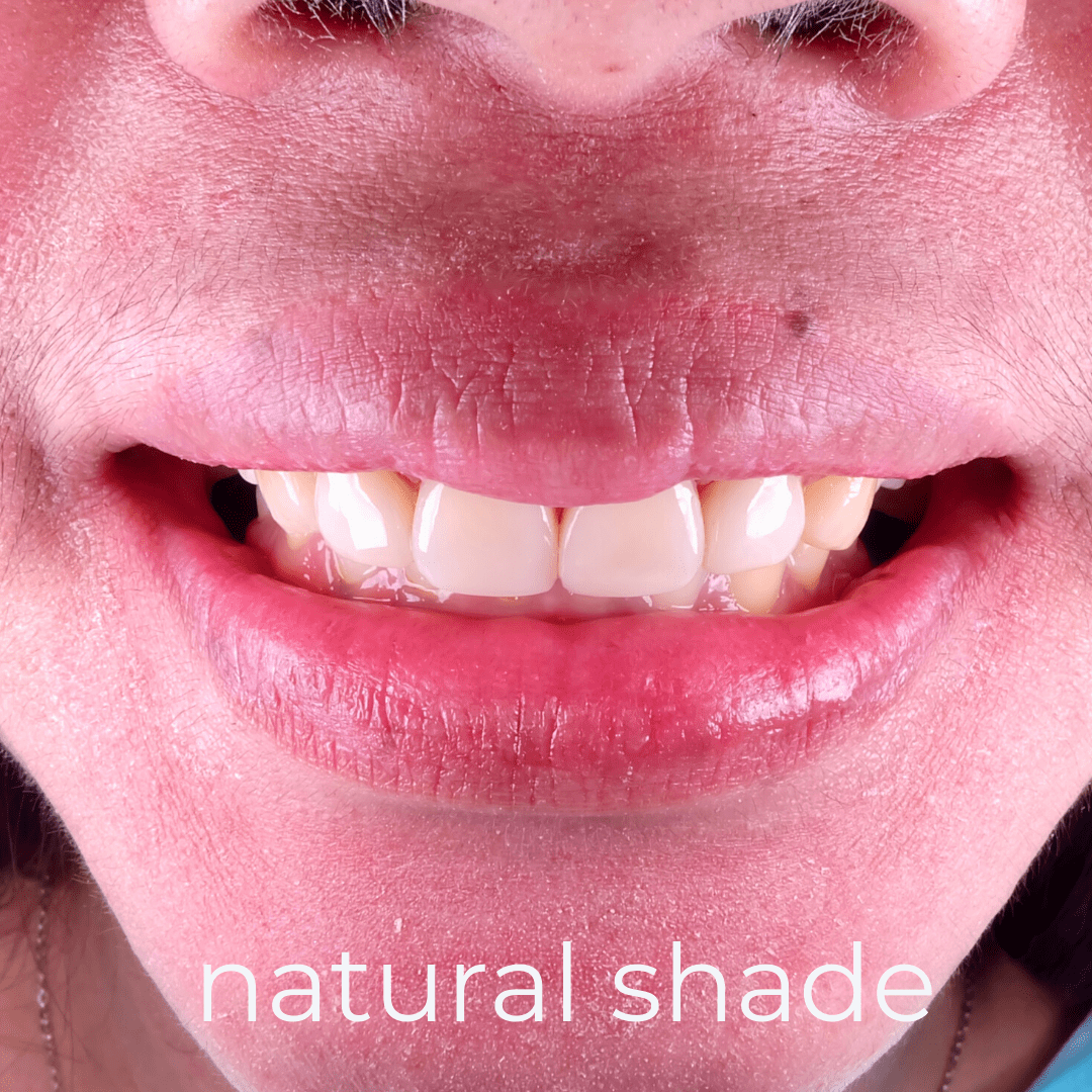 Direct Veneers / Composite Bonding Fidelity Dental Bali