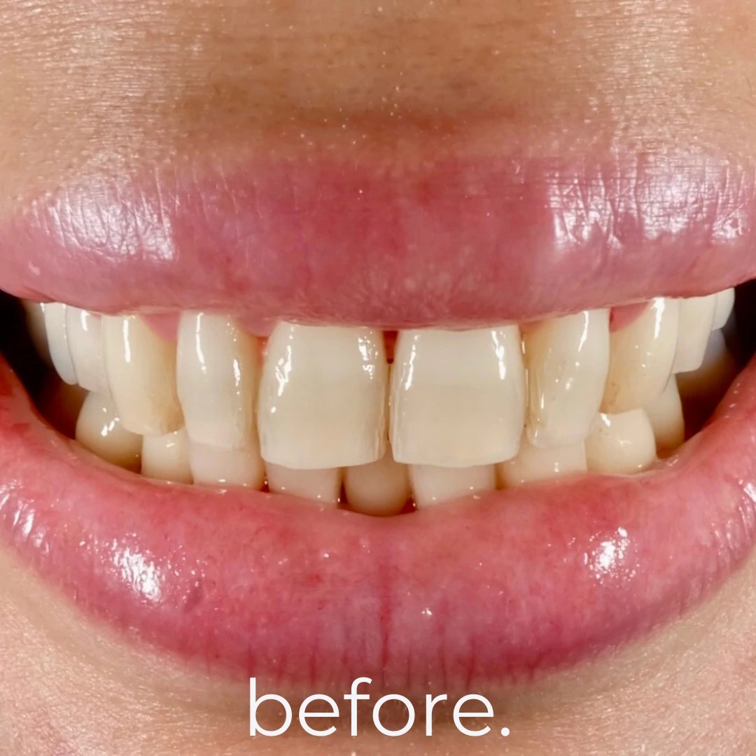 Porcelain Veneers Fidelity Dental Bali