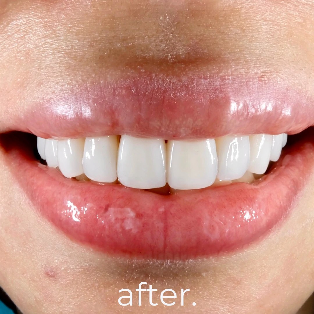 Porcelain Veneers Fidelity Dental Bali