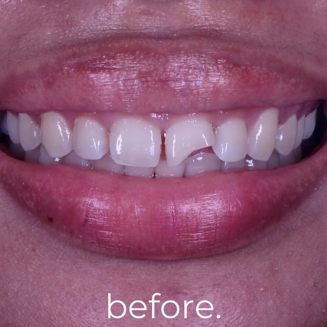 Porcelain Veneers Fidelity Dental Bali