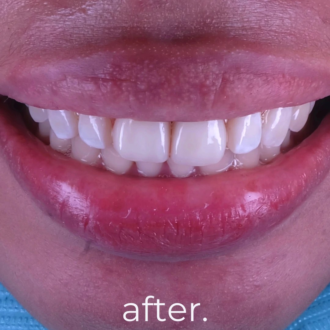 Porcelain Veneers Fidelity Dental Bali