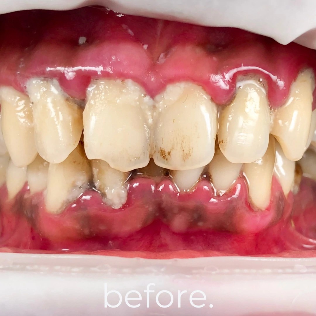 Periodontal Treatments Fidelity Dental Bali