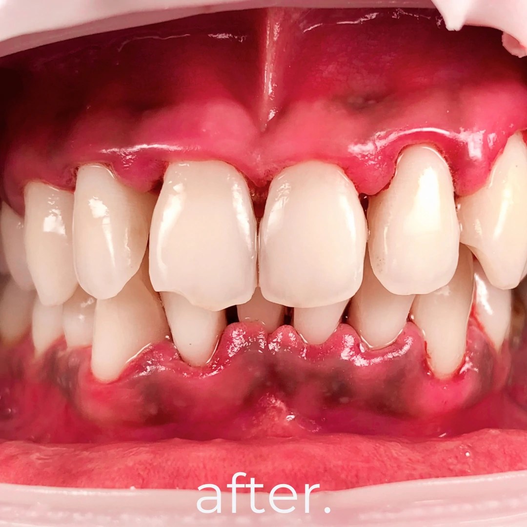 Periodontal Treatments Fidelity Dental Bali