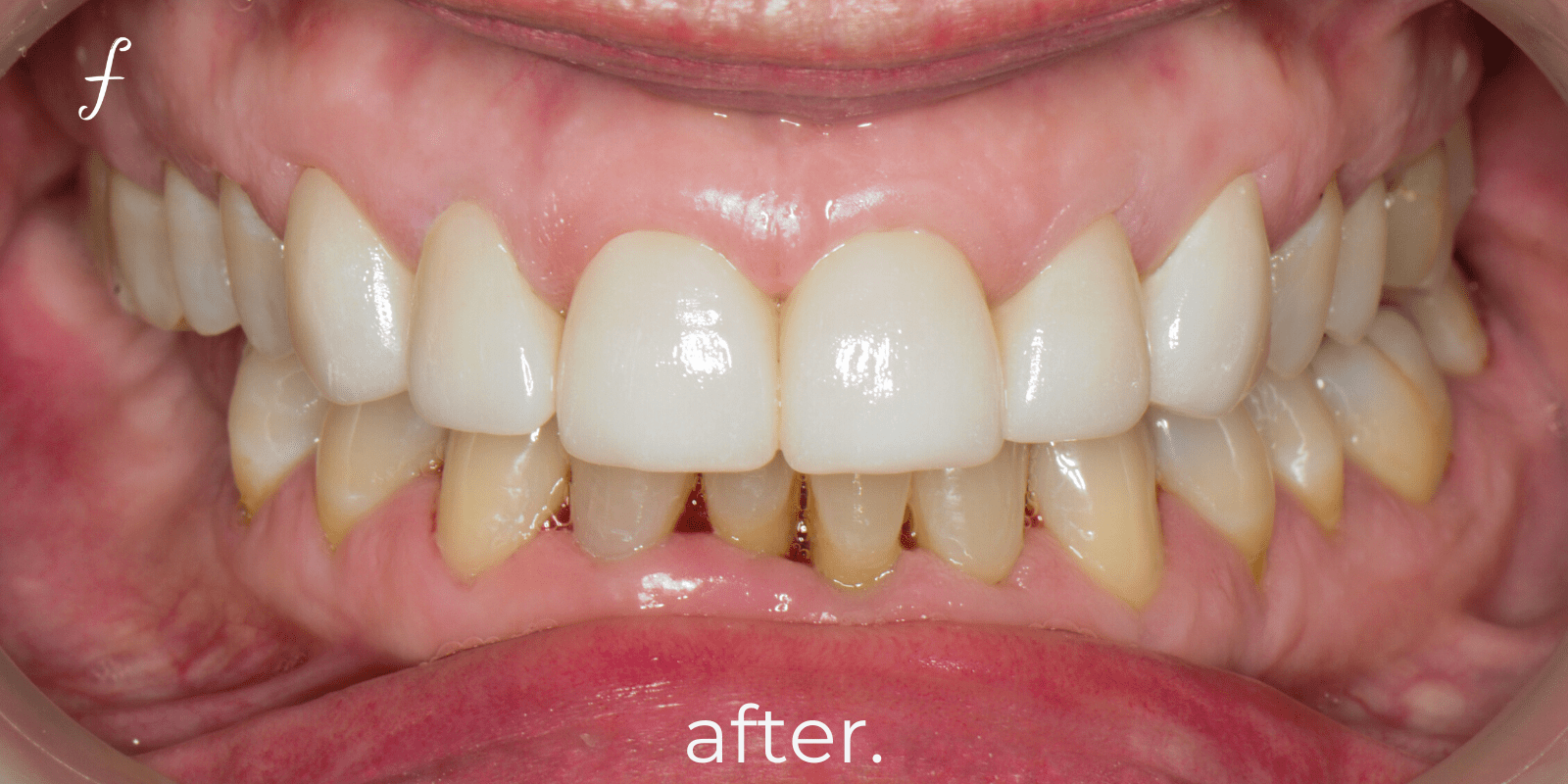 Full Mouth Rehab Fidelity Dental Bali