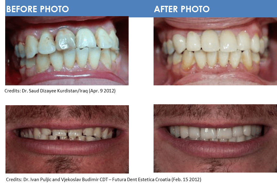 Products Fidelity Dental Lab