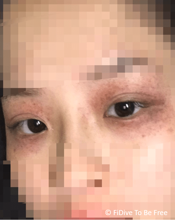 Common Injuries Freediving 101 FiDive to Be Free