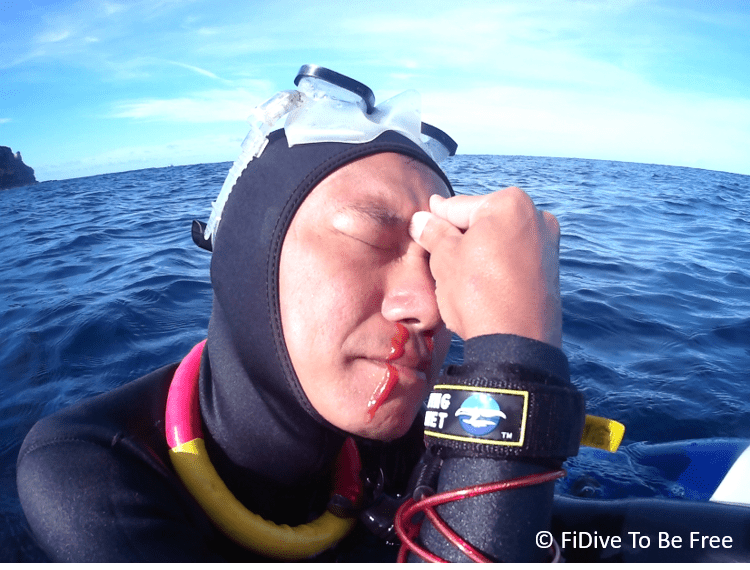 Common Injuries in Freediving FiDive to Be Free