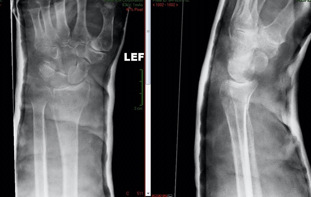 Right Distal Radial Fracture