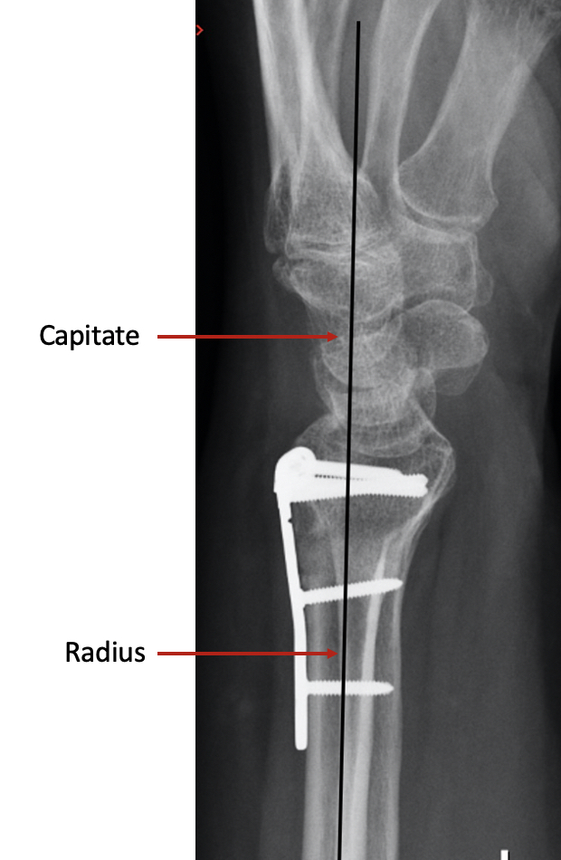 Malunion of the Distal Radius Fife Virtual Hand Clinic