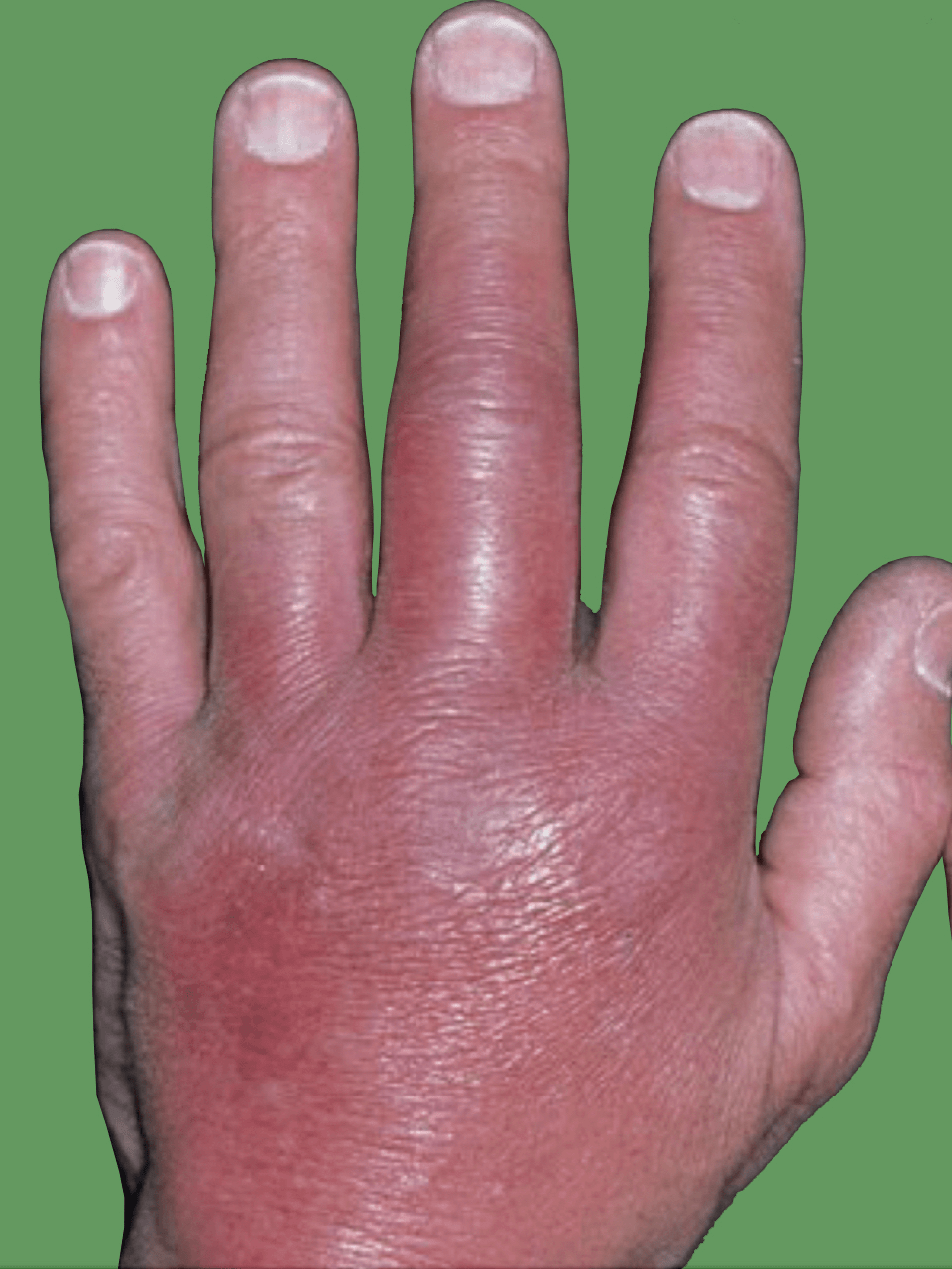 Infection around the Hand and Wrist Fife Virtual Hand Clinic