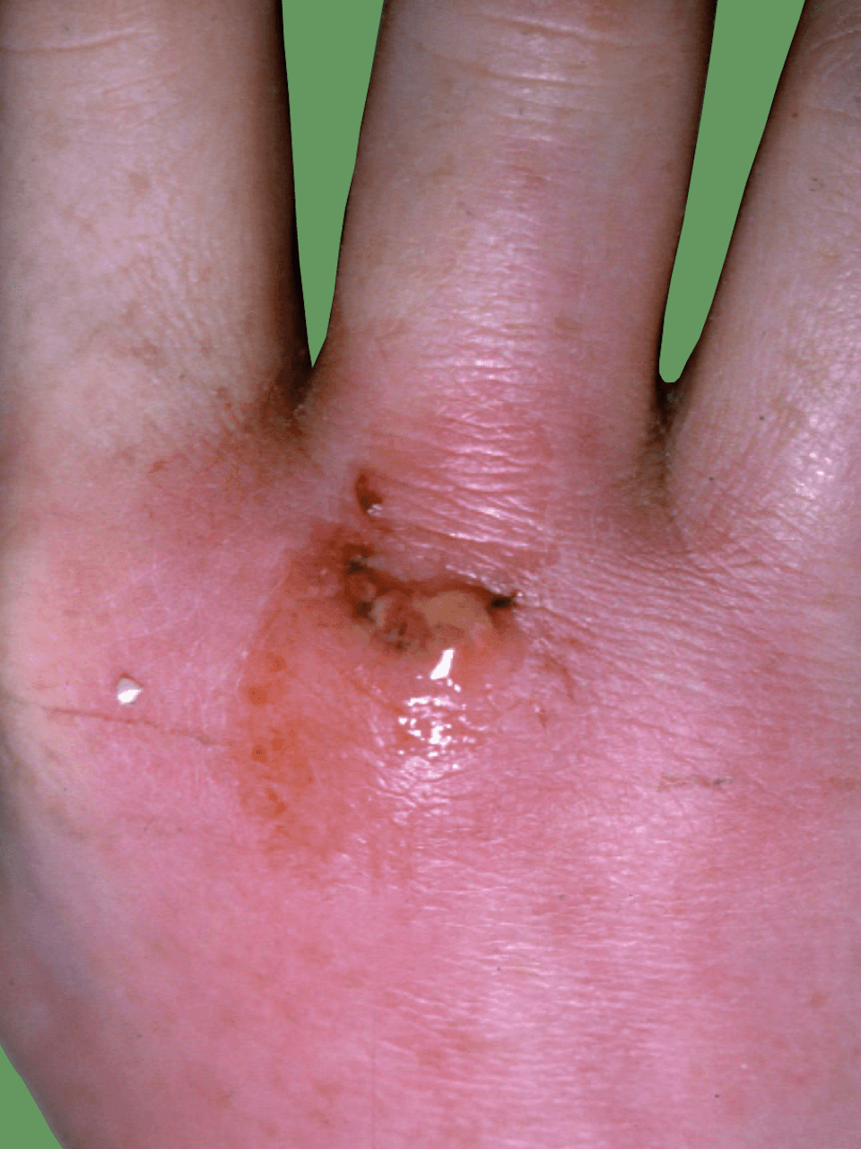 Septic Arthritis Infection of a Joint Fife Virtual Hand Clinic