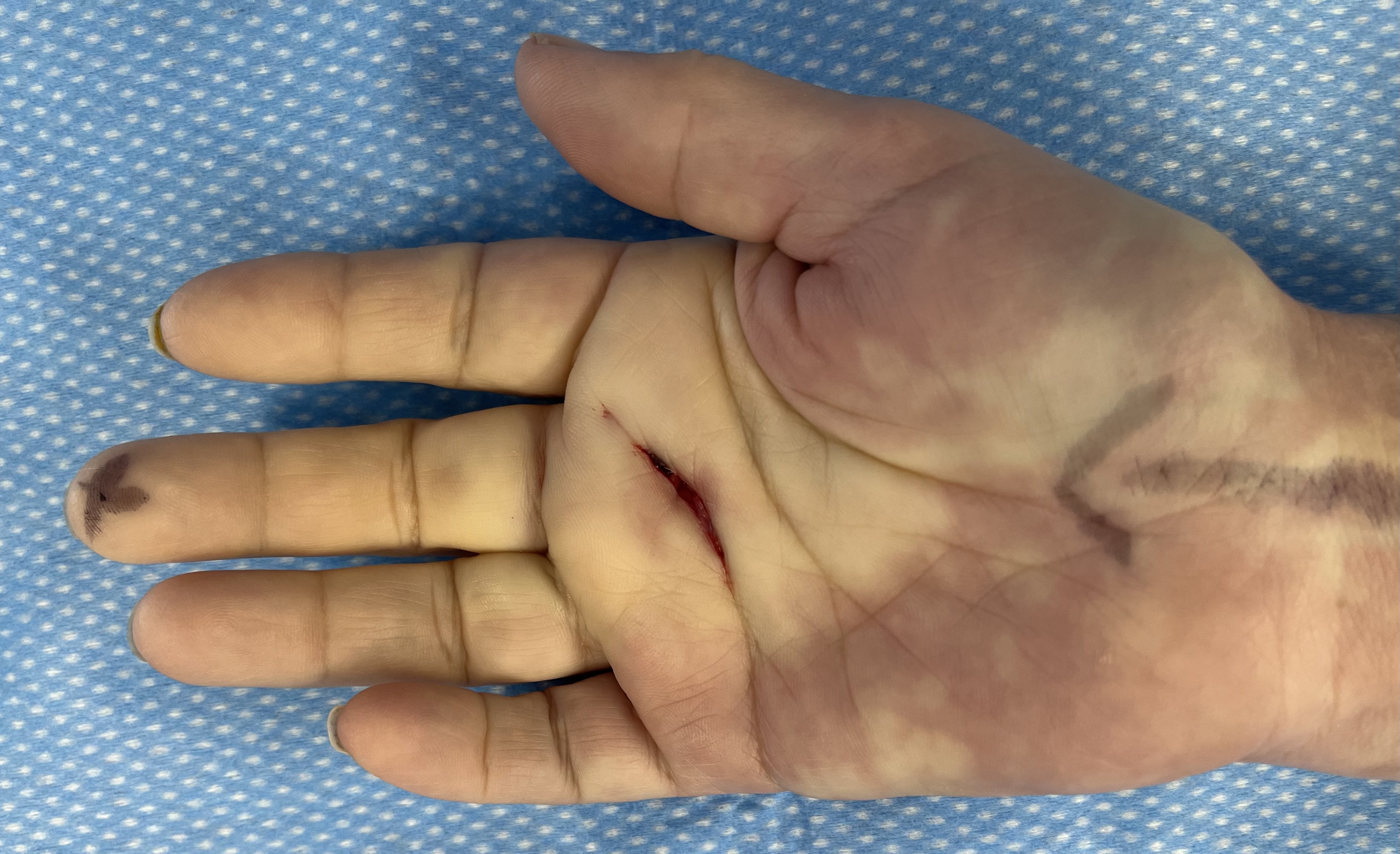 Having a Trigger Finger Release Fife Virtual Hand Clinic