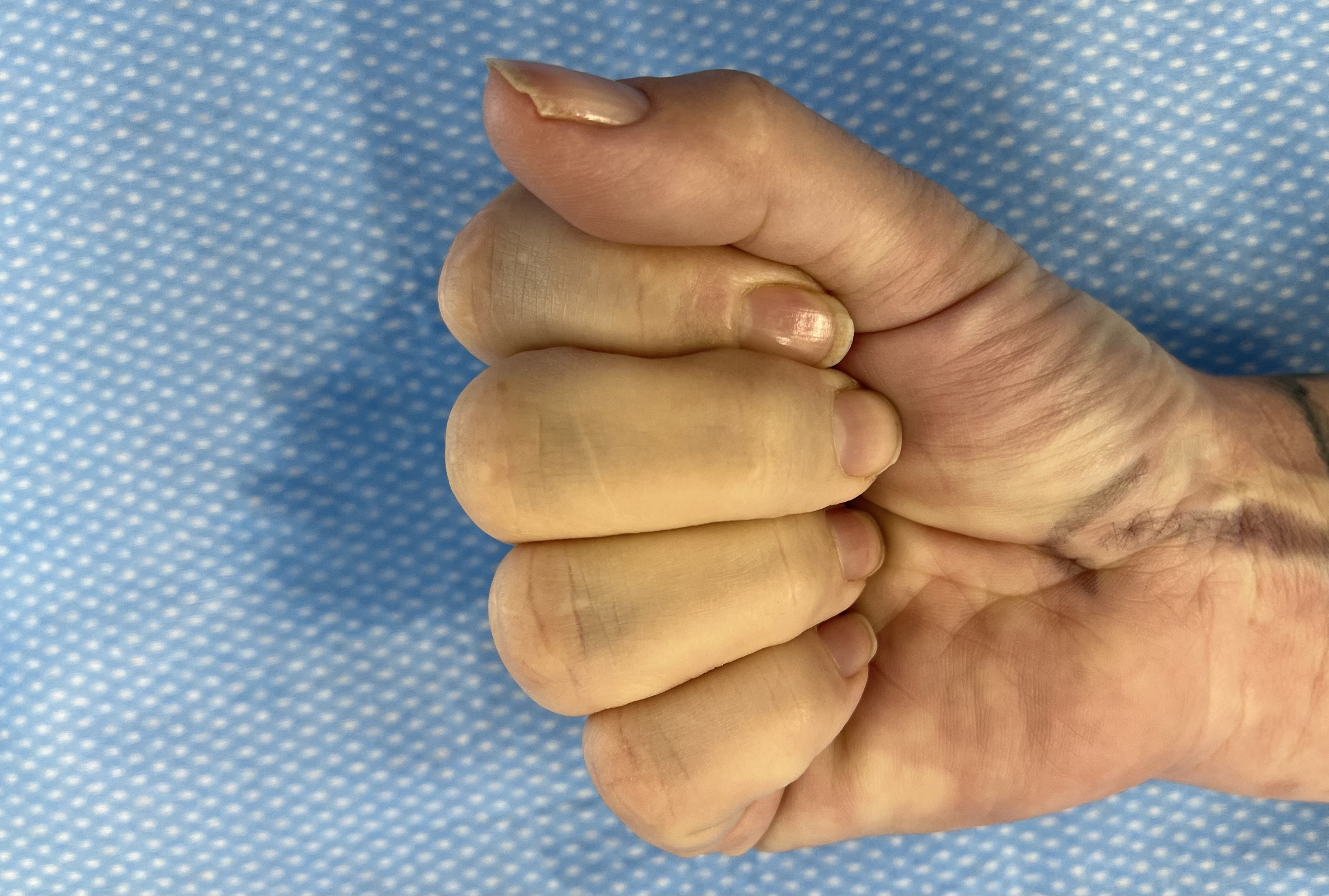 Having a Trigger Finger Release Fife Virtual Hand Clinic