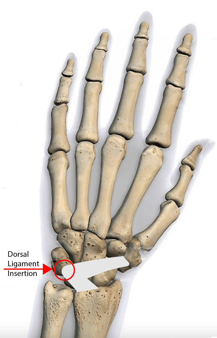 Triquetral Fracture Symptoms