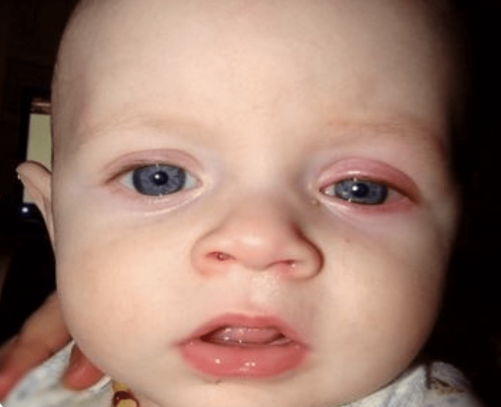 Newborn Care Eyes Philadelphia FIGHT