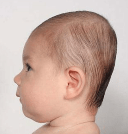 lump on back of baby's head near neck Brigette Finch