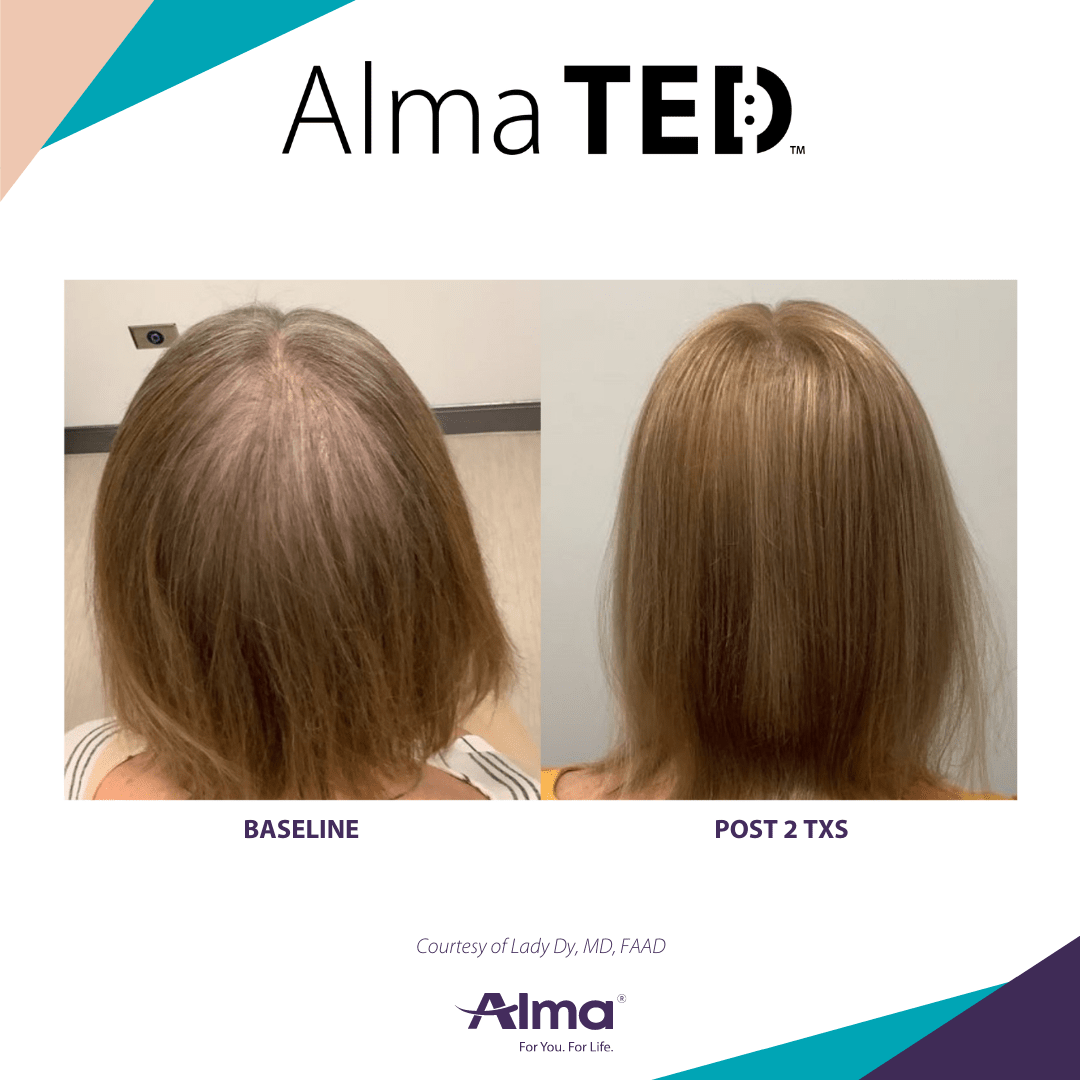 TED HAIR RESTORATION Fig Medical Spa