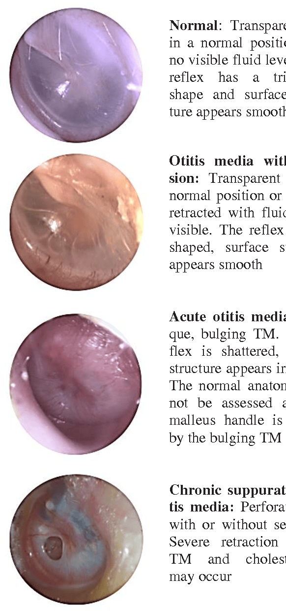 Tympanic Membrane Bulging With Fluid