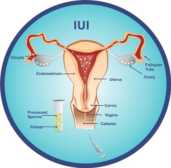 Intrauterine Insemination (IUI) ivfholymothers