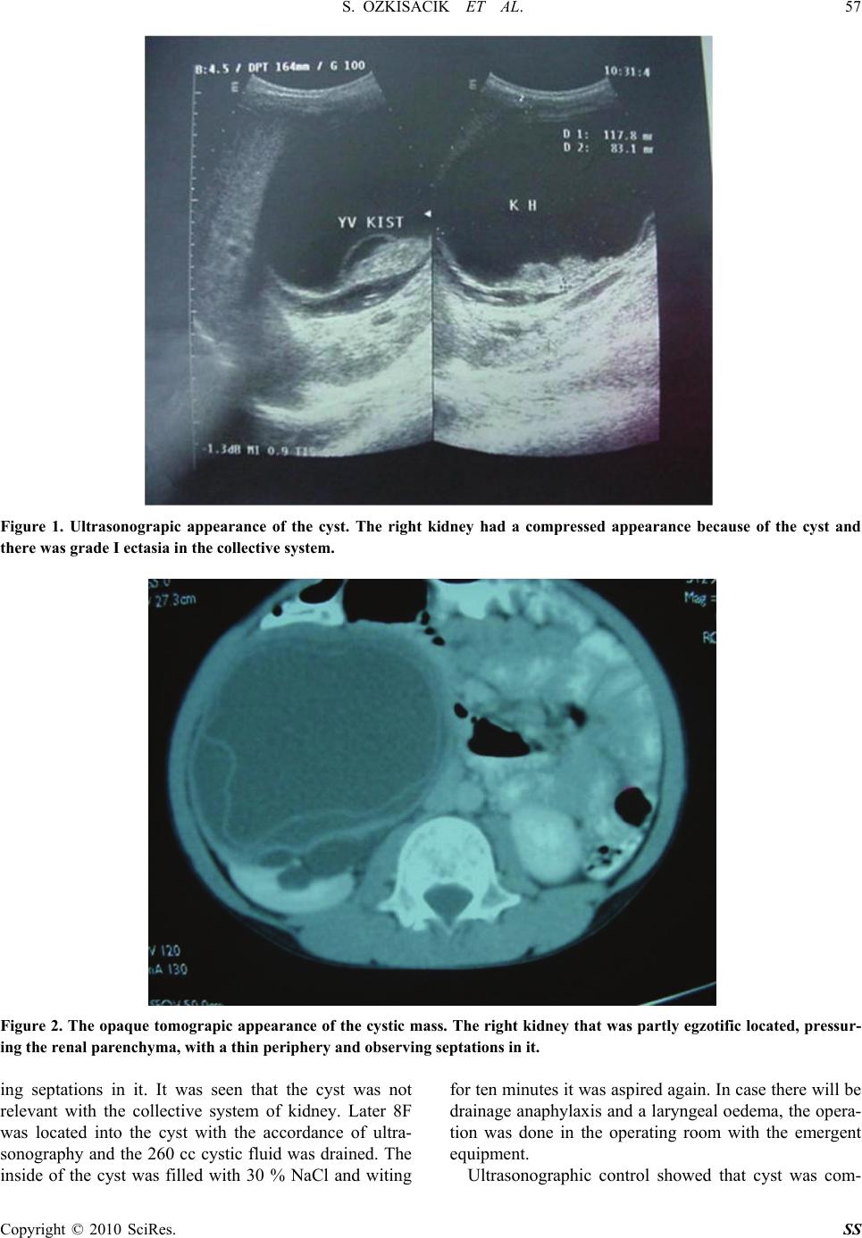 Percutaneous Aspiration of a Renal Hydatid Cyst with Ultrasonographic