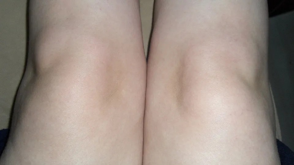 Mitt knä gör ont, men hittar inge fel Hälsa iFokus