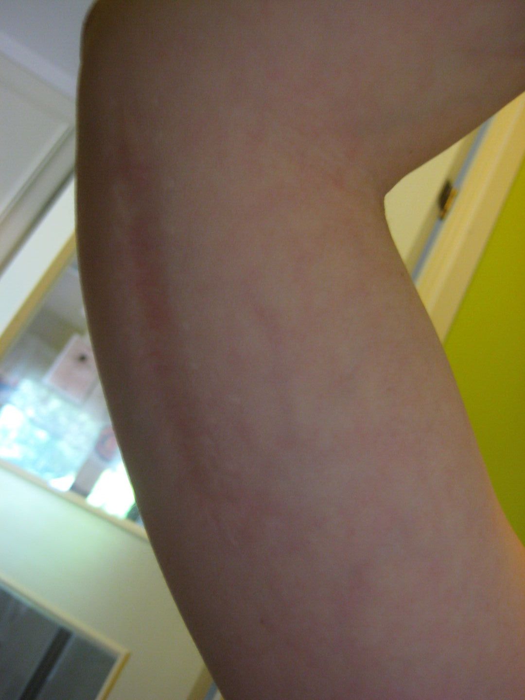 Vanprydande ärr Hälsa iFokus