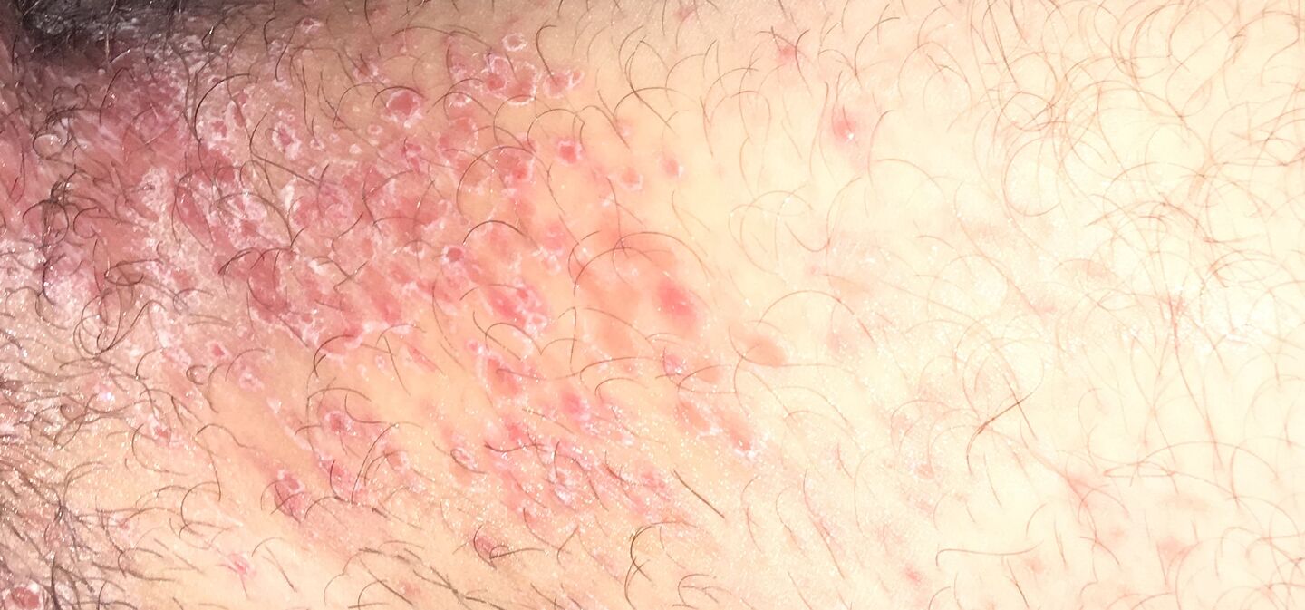 Huden (ljumsken) stark bild. Hälsa iFokus