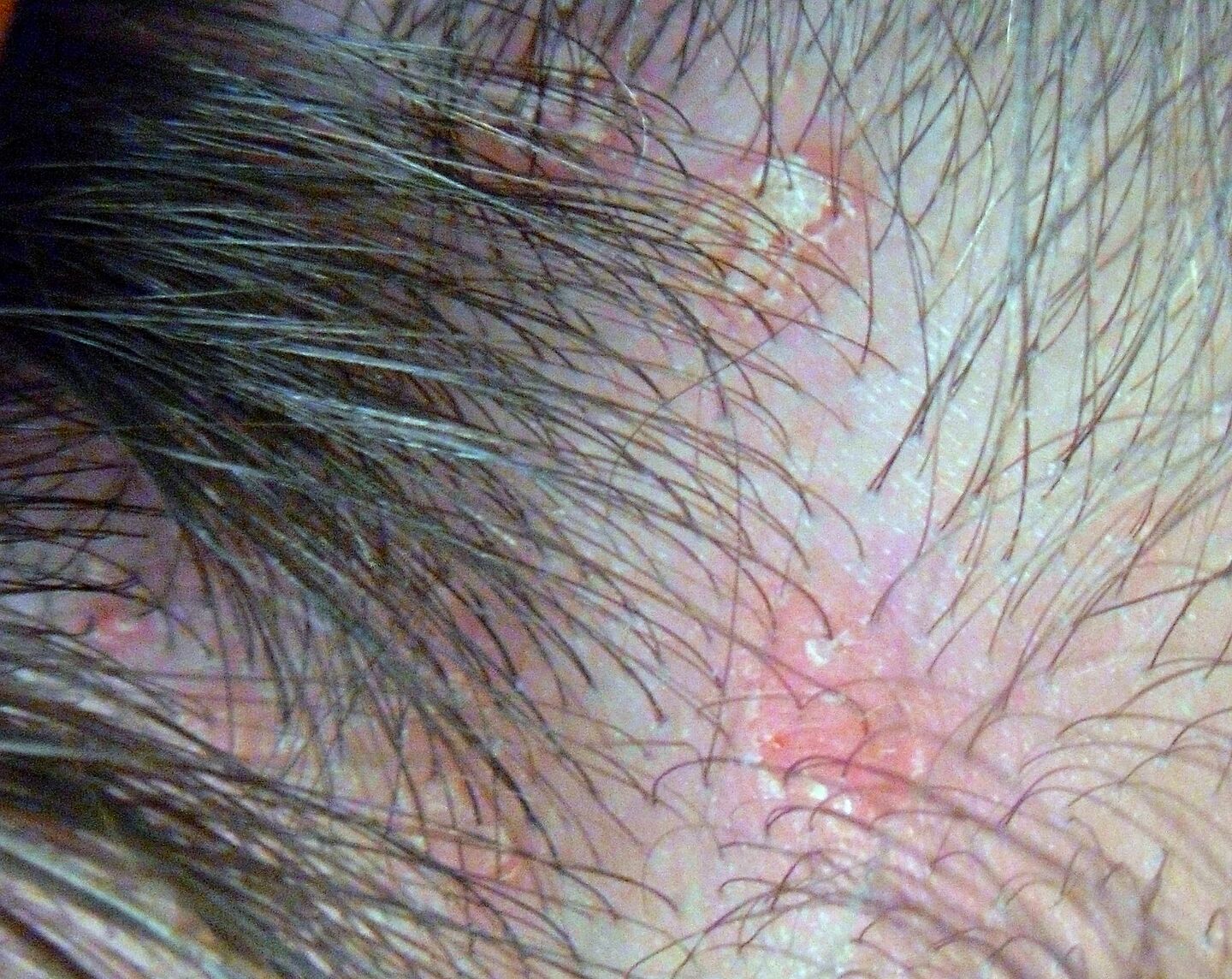 Är detta psoriasis eller mjälleksem? Hälsa iFokus