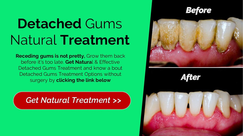 Receding Gums Treatment Cost Captions Blog